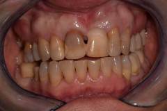 bodent-slucaj-1-zub-2i