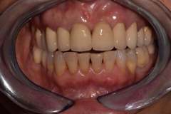 bodent-slucaj-1-zub-3