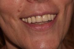 bodent-slucaj-1-zubi