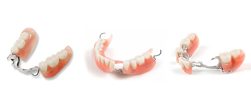 mobilna protetika parcijalna proteza