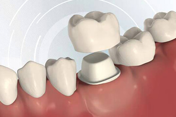 fiksna protetika bodent