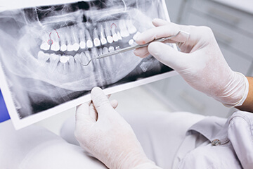 oralna hirurgija bodent