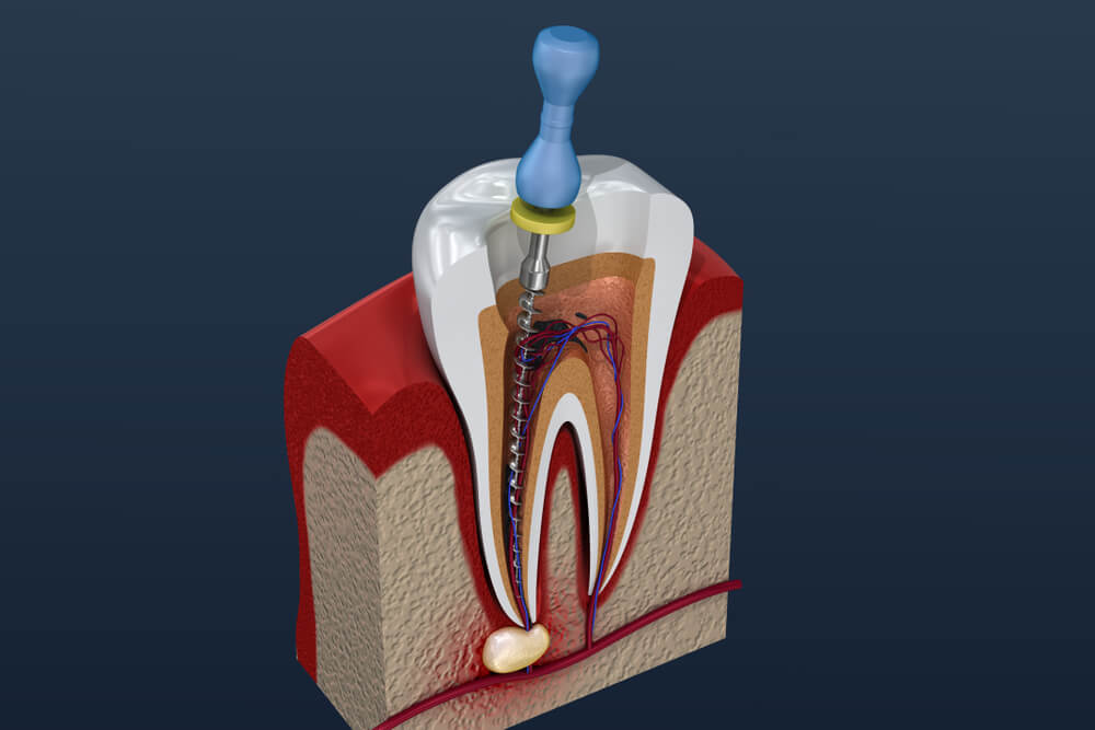 Endodontska terapija