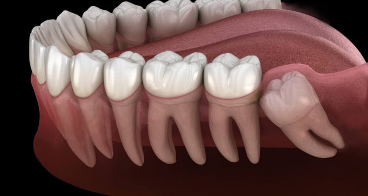 Impaktirani zubi