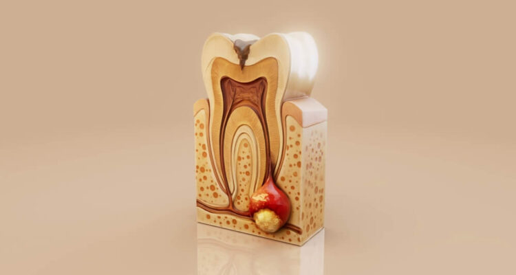 Šta je zubni apsces